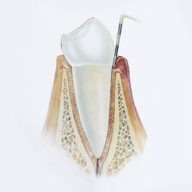 Skizze Zahnfleischentzündung